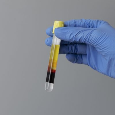 hand-with-glove-holding-vial-prp